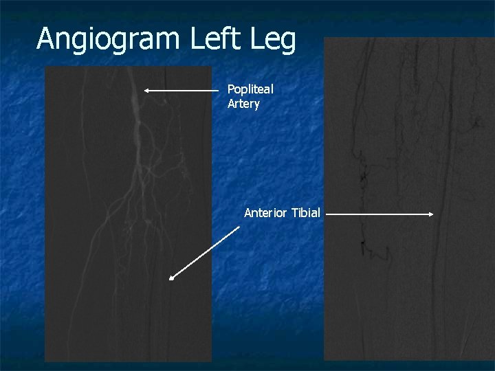Angiogram Left Leg Popliteal Artery Anterior Tibial 