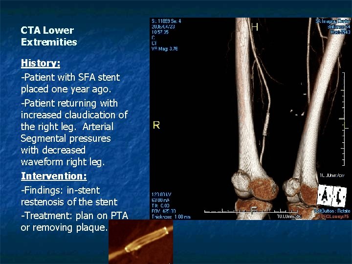 CTA Lower Extremities History: -Patient with SFA stent placed one year ago. -Patient returning