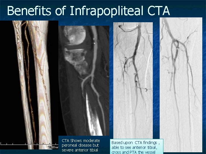 Benefits of Infrapopliteal CTA Shows moderate peroneal disease but severe anterior tibial Based upon