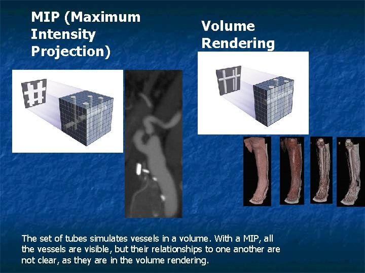 MIP (Maximum Intensity Projection) Volume Rendering The set of tubes simulates vessels in a