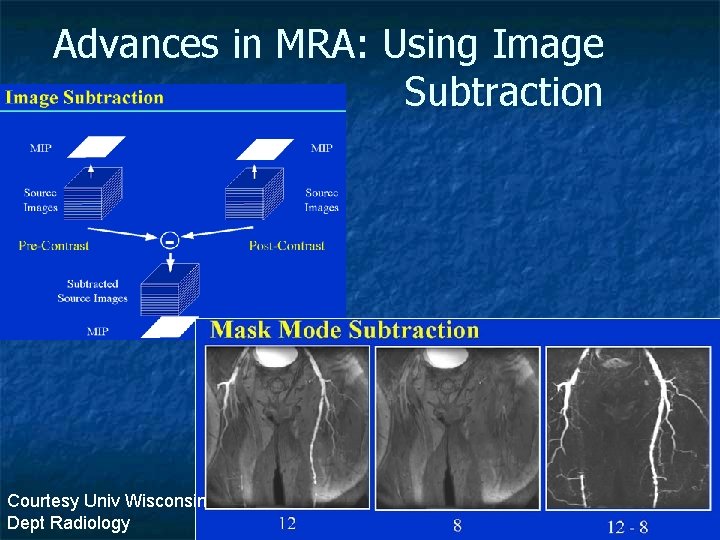 Advances in MRA: Using Image Subtraction Courtesy Univ Wisconsin Dept Radiology 