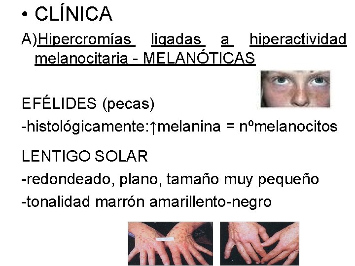  • CLÍNICA A)Hipercromías ligadas a hiperactividad melanocitaria - MELANÓTICAS EFÉLIDES (pecas) -histológicamente: ↑melanina