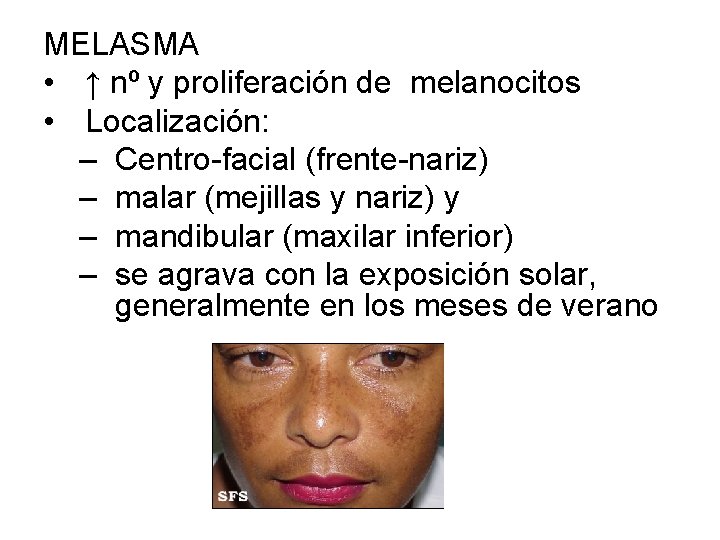 MELASMA • ↑ nº y proliferación de melanocitos • Localización: – Centro-facial (frente-nariz) –