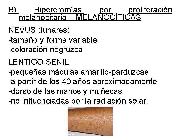 B) Hipercromías por proliferación melanocitaria – MELANOCÍTICAS NEVUS (lunares) -tamaño y forma variable -coloración