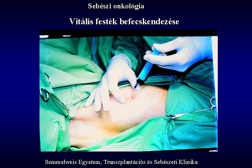 Sebészi onkológia Vitális festék befecskendezése Semmelweis Egyetem, Transzplantációs és Sebészeti Klinika 