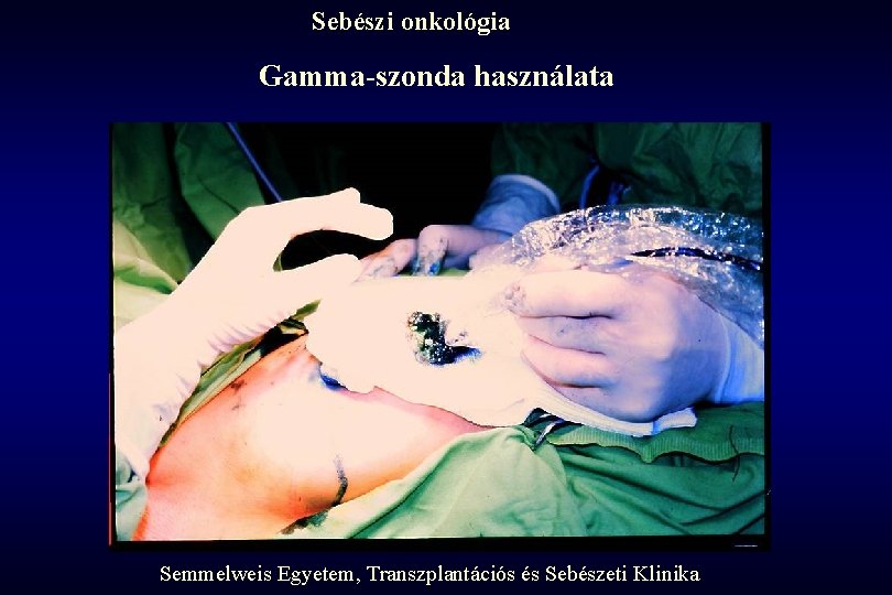 Sebészi onkológia Gamma-szonda használata Semmelweis Egyetem, Transzplantációs és Sebészeti Klinika 