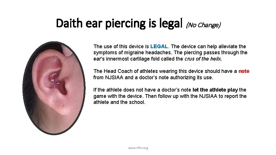 Daith ear piercing is legal (No Change) The use of this device is LEGAL.