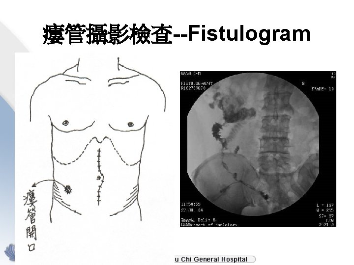 瘻管攝影檢查--Fistulogram 
