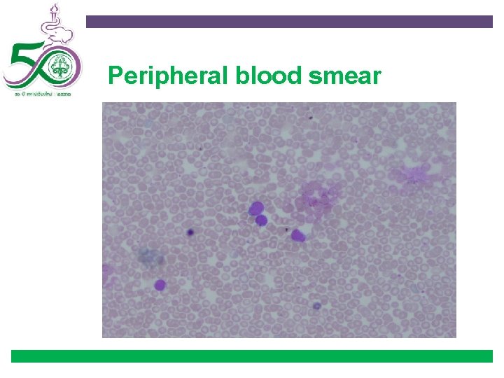 Peripheral blood smear 