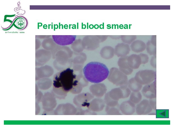 Peripheral blood smear 