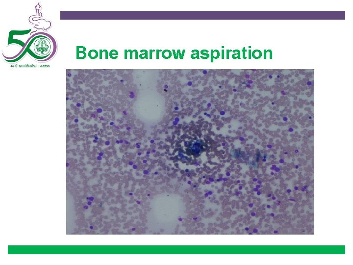 Bone marrow aspiration 