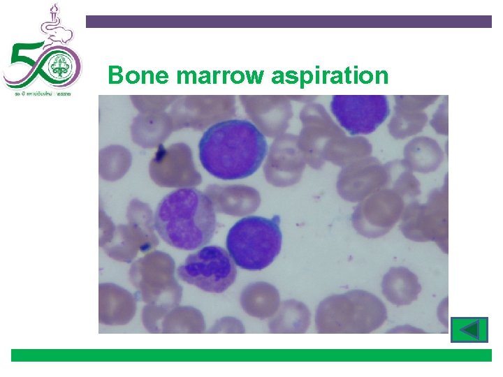 Bone marrow aspiration 