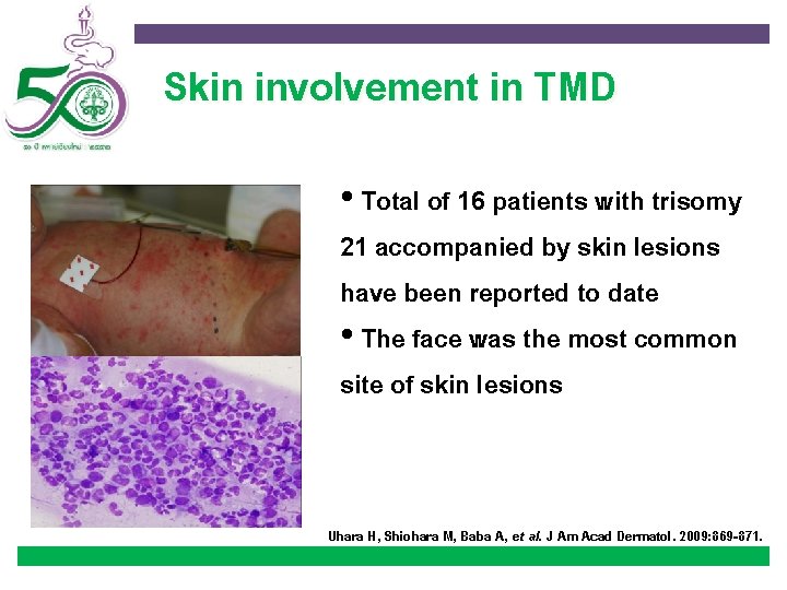 Skin involvement in TMD • Total of 16 patients with trisomy 21 accompanied by