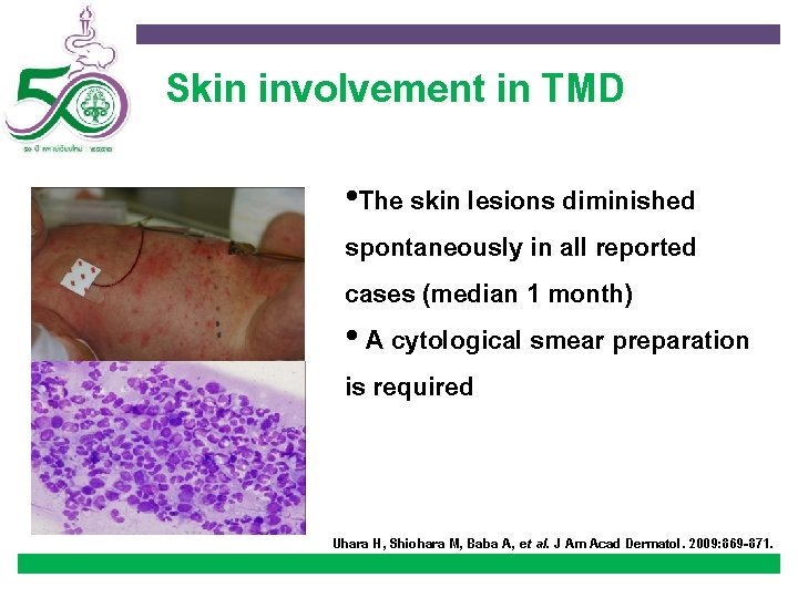 Skin involvement in TMD • The skin lesions diminished spontaneously in all reported cases