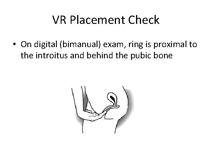 VR Placement Check • On digital (bimanual) exam, ring is proximal to the introitus