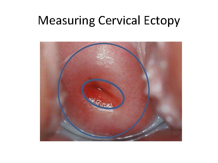 Measuring Cervical Ectopy 