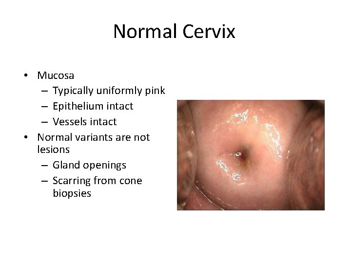 Normal Cervix • Mucosa – Typically uniformly pink – Epithelium intact – Vessels intact