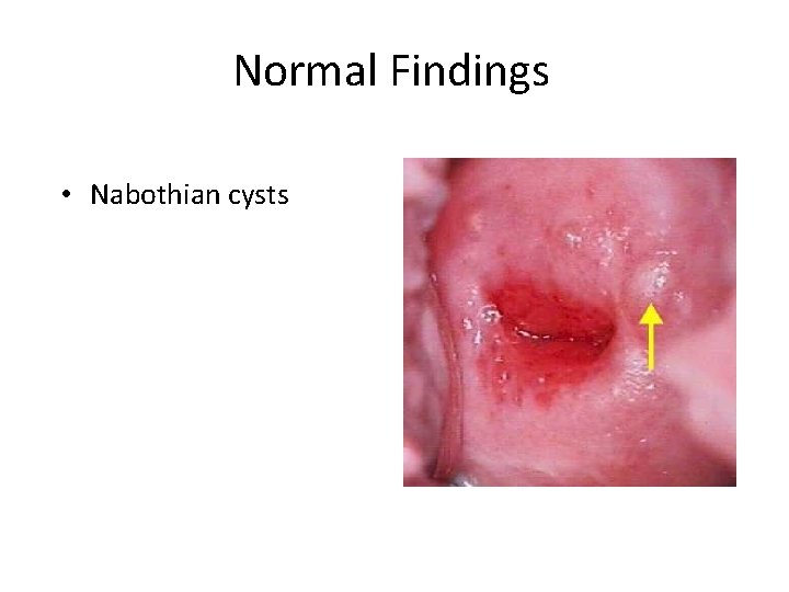 Normal Findings • Nabothian cysts 