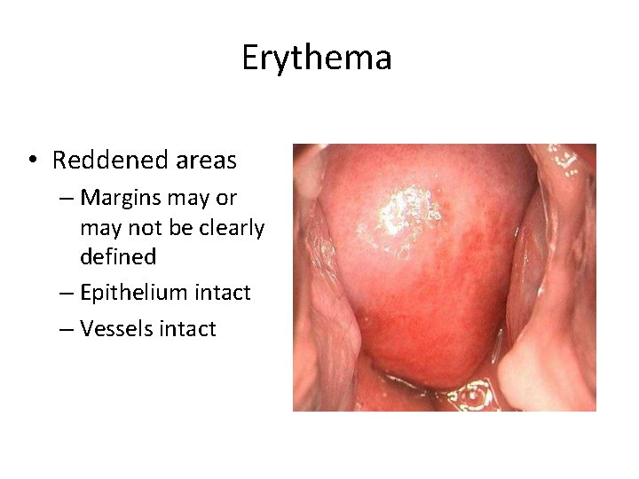 Erythema • Reddened areas – Margins may or may not be clearly defined –