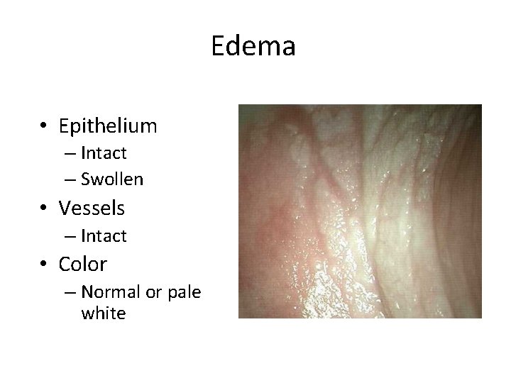 Edema • Epithelium – Intact – Swollen • Vessels – Intact • Color –