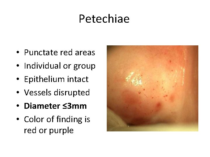 Petechiae • • • Punctate red areas Individual or group Epithelium intact Vessels disrupted