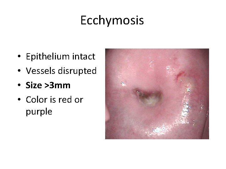 Ecchymosis • • Epithelium intact Vessels disrupted Size >3 mm Color is red or