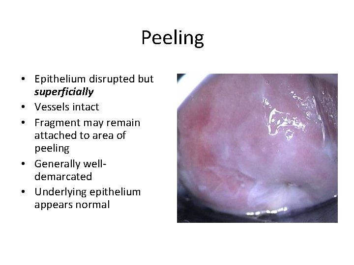 Peeling • Epithelium disrupted but superficially • Vessels intact • Fragment may remain attached