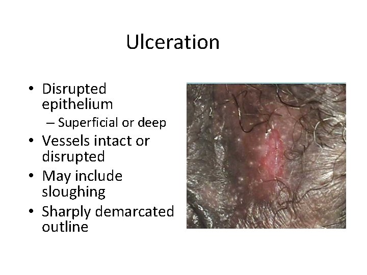 Ulceration • Disrupted epithelium – Superficial or deep • Vessels intact or disrupted •