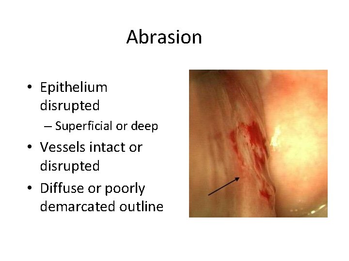 Abrasion • Epithelium disrupted – Superficial or deep • Vessels intact or disrupted •