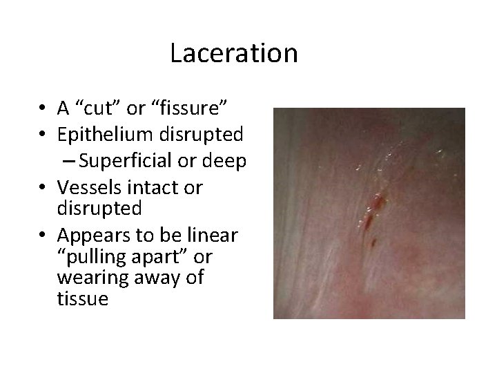 Laceration • A “cut” or “fissure” • Epithelium disrupted – Superficial or deep •