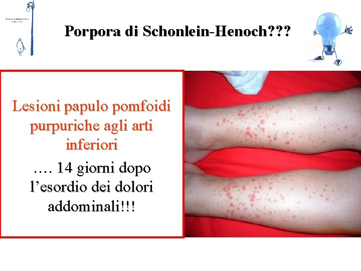 Porpora di Schonlein-Henoch? ? ? • Esame obiettivo cutaneo • Esamepapulo urine pomfoidi Lesioni