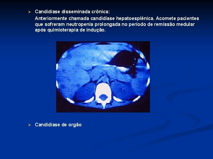 Ø Candidíase disseminada crônica: Anteriormente chamada candidíase hepatoesplênica. Acomete pacientes que sofreram neutropenia prolongada