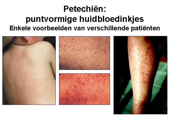 Petechiën: puntvormige huidbloedinkjes Enkele voorbeelden van verschillende patiënten 
