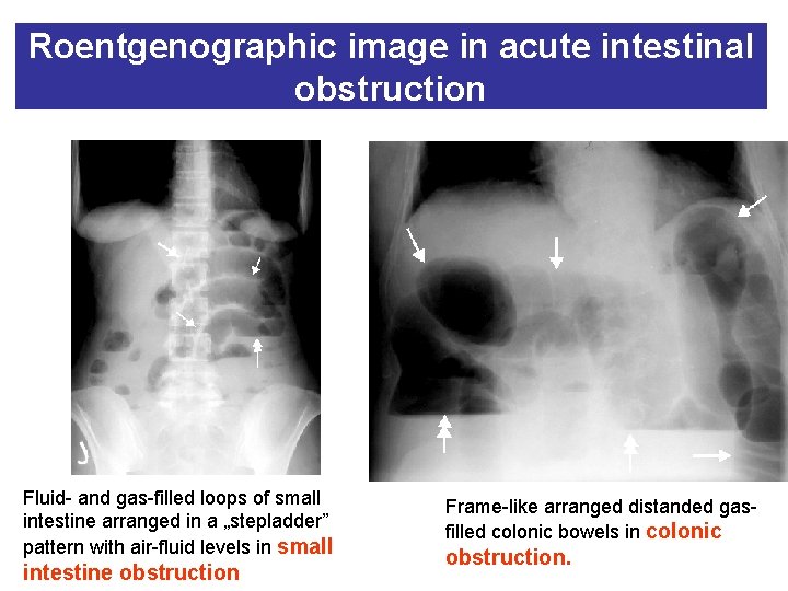 Roentgenographic image in acute intestinal obstruction Fluid- and gas-filled loops of small intestine arranged