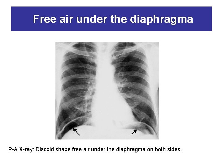 Free air under the diaphragma P-A X-ray: Discoid shape free air under the diaphragma