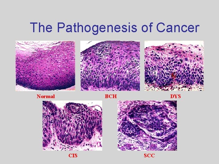 The Pathogenesis of Cancer Normal BCH CIS DYS SCC 