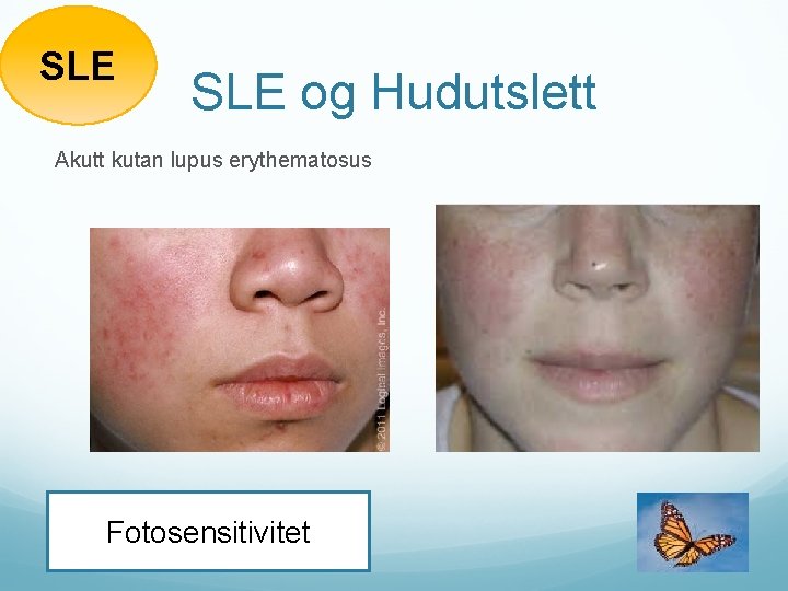 SLE og Hudutslett Akutt kutan lupus erythematosus Fotosensitivitet 