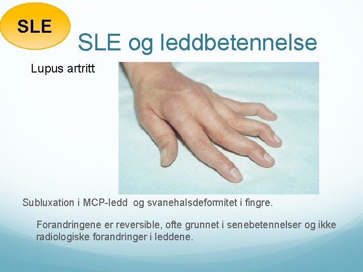 SLE og leddbetennelse Lupus artritt Subluxation i MCP-ledd og svanehalsdeformitet i fingre. Forandringene er