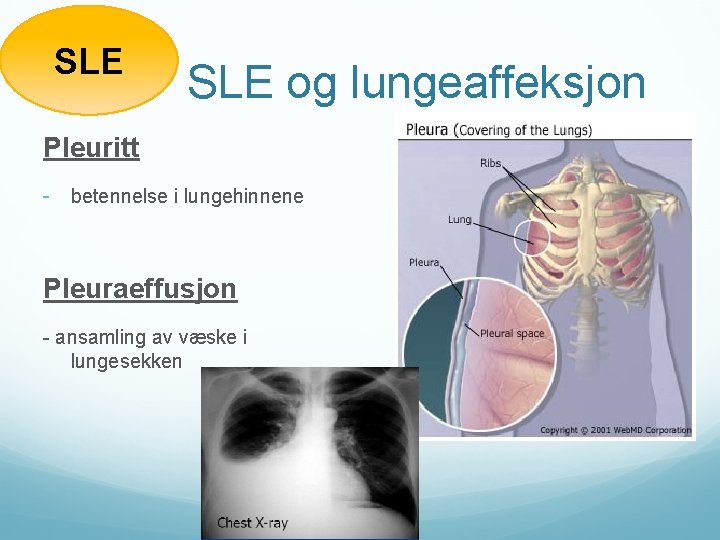 SLE og lungeaffeksjon Pleuritt - betennelse i lungehinnene Pleuraeffusjon - ansamling av væske i