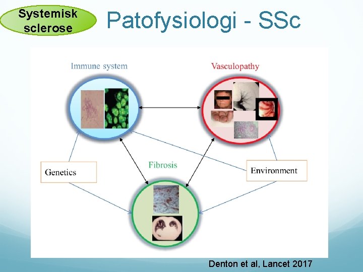 Systemisk sclerose Patofysiologi - SSc Denton et al, Lancet 2017 