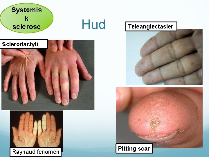Systemis k sclerose Hud Teleangiectasier Sclerodactyli Raynaud fenomen Pitting scar 