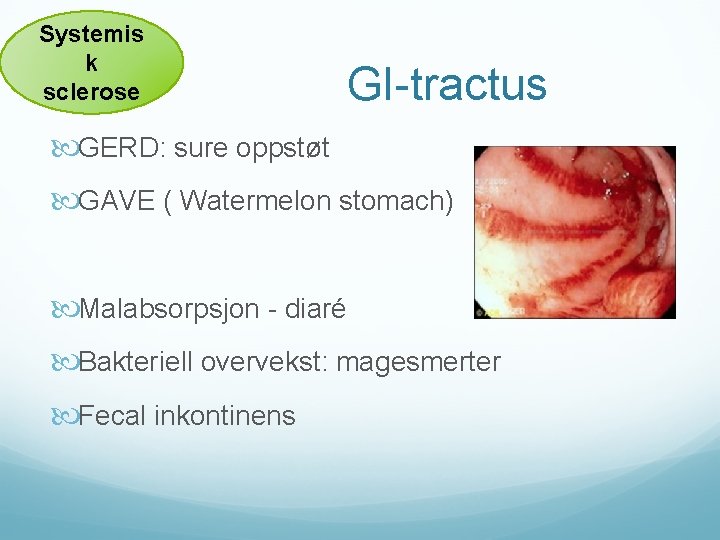 Systemis k sclerose GI-tractus GERD: sure oppstøt GAVE ( Watermelon stomach) Malabsorpsjon - diaré