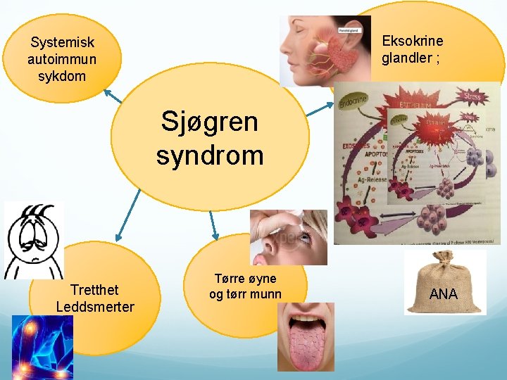 Eksokrine glandler ; Systemisk autoimmun sykdom Epitelitt Sjøgren syndrom Tretthet Leddsmerter Tørre øyne og