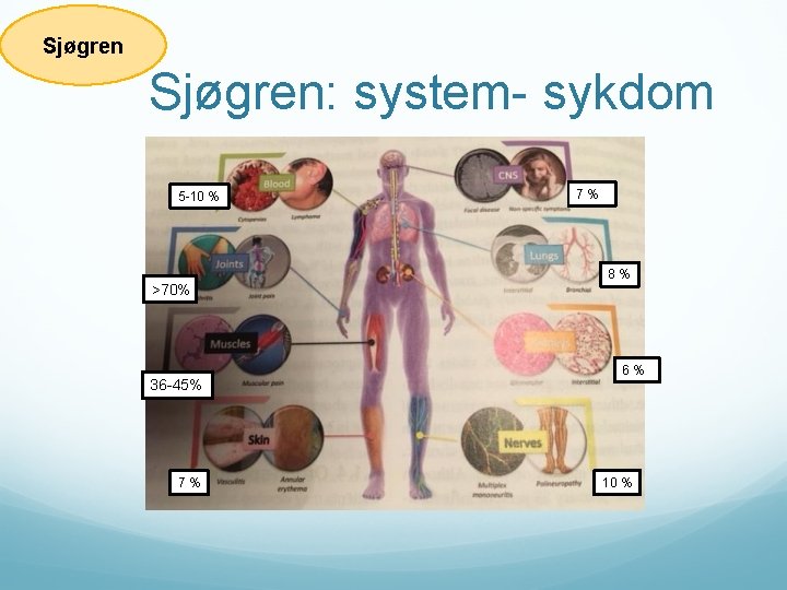 Sjøgren: system- sykdom 5 -10 % >70% 36 -45% 7 % 8 % 6