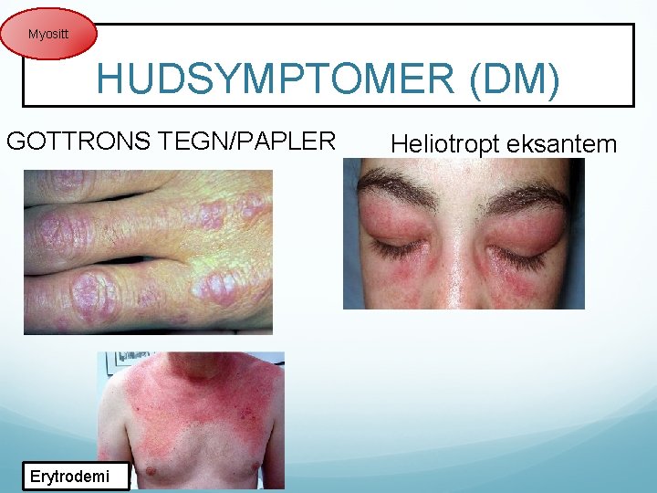 Myositt HUDSYMPTOMER (DM) GOTTRONS TEGN/PAPLER Erytrodemi Heliotropt eksantem 