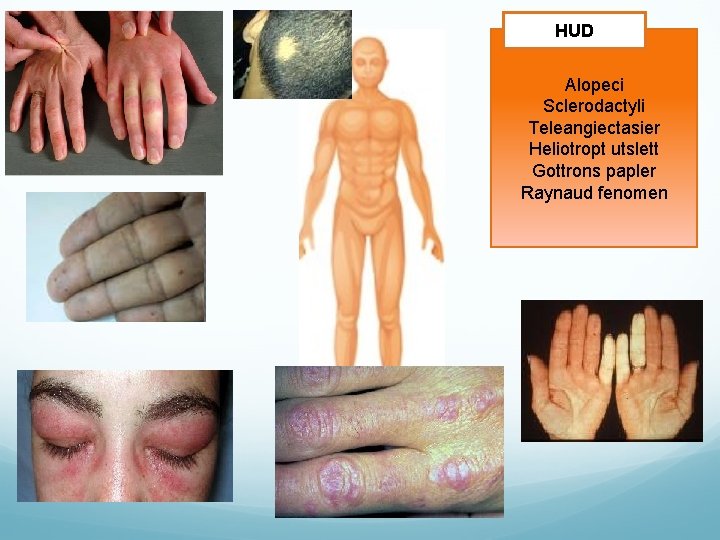 HUD Alopeci Sclerodactyli Teleangiectasier Heliotropt utslett Gottrons papler Raynaud fenomen 