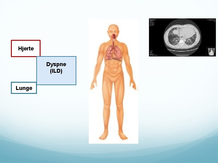 Hjerte Dyspne (ILD) Lunge 