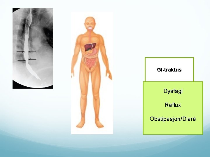 GI-traktus Dysfagi Reflux Obstipasjon/Diaré 