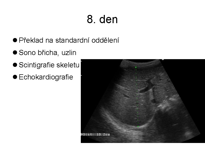 8. den Překlad na standardní oddělení Sono břicha, uzlin Scintigrafie skeletu Echokardiografie 