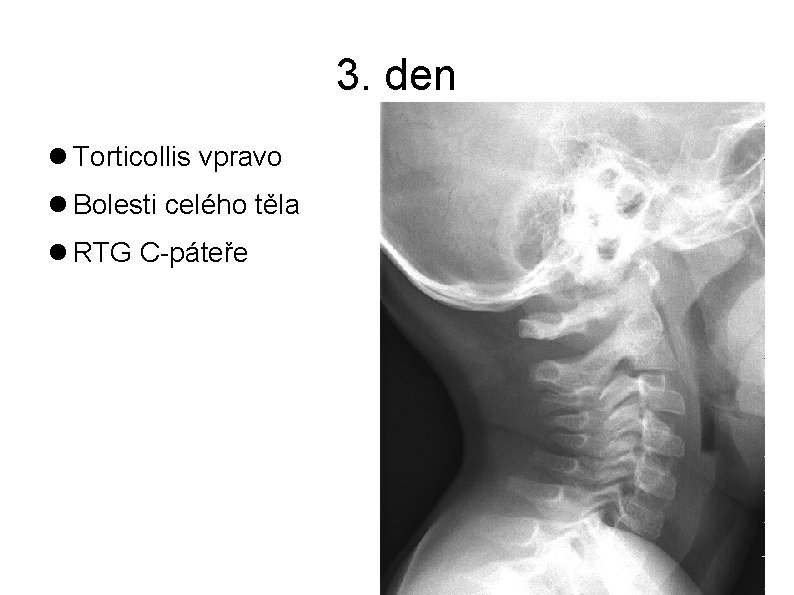 3. den Torticollis vpravo Bolesti celého těla RTG C-páteře 